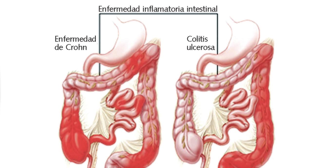 Imágenes de Colitis ulcerosa y enfermedad de Crohn