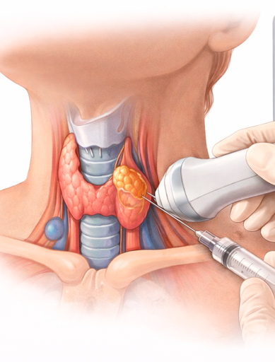 Ablaci&oacute;n de N&oacute;dulo Tiroideo