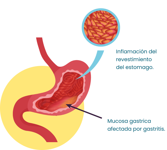 Gastritis