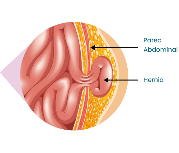 Hernias